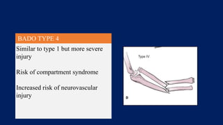 BADO TYPE 4
Similar to type 1 but more severe
injury
Risk of compartment syndrome
Increased risk of neurovascular
injury
 