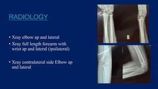 RADIOLOGY
• Xray elbow ap and lateral
• Xray full length forearm with
wrist ap and lateral (ipsilateral)
• Xray contralateral side Elbow ap
and lateral
 