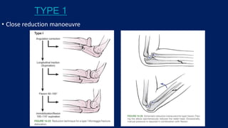 TYPE 1
• Close reduction manoeuvre
 