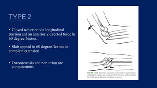 TYPE 2
• Closed reduction via longitudinal
traction and an anteriorly directed force in
60 degree flexion.
• Slab applied in 60 degree flexion or
complete extension.
• Osteonecrosis and non union are
complications
 