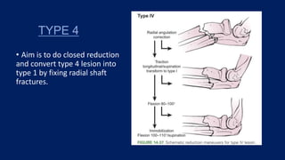 TYPE 4
• Aim is to do closed reduction
and convert type 4 lesion into
type 1 by fixing radial shaft
fractures.
 