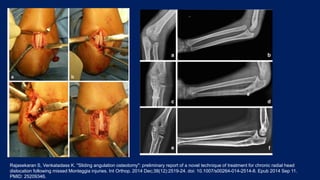 Rajasekaran S, Venkatadass K. "Sliding angulation osteotomy": preliminary report of a novel technique of treatment for chronic radial head
dislocation following missed Monteggia injuries. Int Orthop. 2014 Dec;38(12):2519-24. doi: 10.1007/s00264-014-2514-8. Epub 2014 Sep 11.
PMID: 25209346.
 