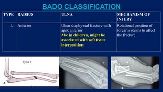BADO CLASSIFICATION
TYPE RADIUS ULNA MECHANISM OF
INJURY
1. Anterior Ulnar diaphyseal fracture with
apex anterior
M/c in children, might be
associated with soft tissue
interposition
Rotational position of
forearm seems to affect
the fracture
 