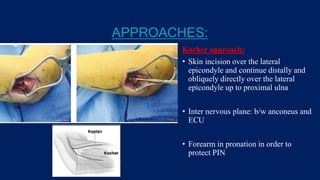 APPROACHES:
Kocher approach:
• Skin incision over the lateral
epicondyle and continue distally and
obliquely directly over the lateral
epicondyle up to proximal ulna
• Inter nervous plane: b/w anconeus and
ECU
• Forearm in pronation in order to
protect PIN
 