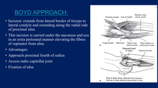 BOYD APPROACH:
• Incision: extends from lateral border of triceps to
lateral condyle and extending along the radial side
of proximal ulna.
• This incision is carried under the anconeus and ecu
in an extra periosteal manner elevating the fibres
of supinator from ulna.
• Advantages:
• Approach proximal fourth of radius
• Access radio capitellar joint
• Fixation of ulna
 