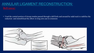 ANNULAR LIGAMENT RECONSTRUCTION:
Bell tawse:
• Used the central portion of triceps tendon passed through a drill hole and around he radal neck to stabilise the
reduction and immobilised the elbow in long arm cast in extension
 