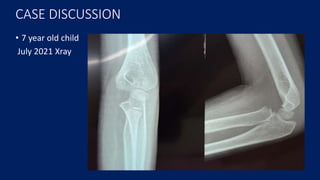 CASE DISCUSSION
• 7 year old child
July 2021 Xray
 