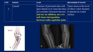 3.
Lateral Fracture of proximal ulna with
apex lateral or in varus but does
not consider olecranon fracture
2nd m/c in children, m/c a/w
soft tissue interposition
between radio capitellar joint
Varus stress at the level
of elbow when forearm
is planted on a hard
surface
TYPE RADIUS ULNA MECHANISM OF INJURY
 