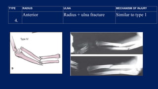 4.
Anterior Radius + ulna fracture Similar to type 1
TYPE RADIUS ULNA MECHANISM OF INJURY
 