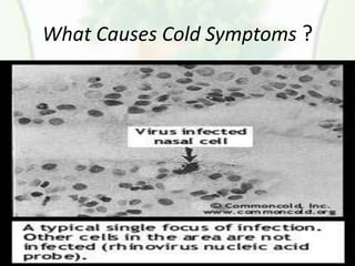 What Causes Cold Symptoms ?
 