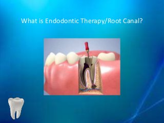 What is Endodontic Therapy/Root Canal?
 