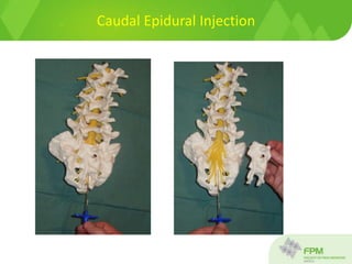 Caudal Epidural Injection
 