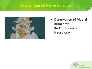 Medial Branch Nerve Ablation
• Denervation of Medial
Branch via
Radiofrequency
Neurotomy
 