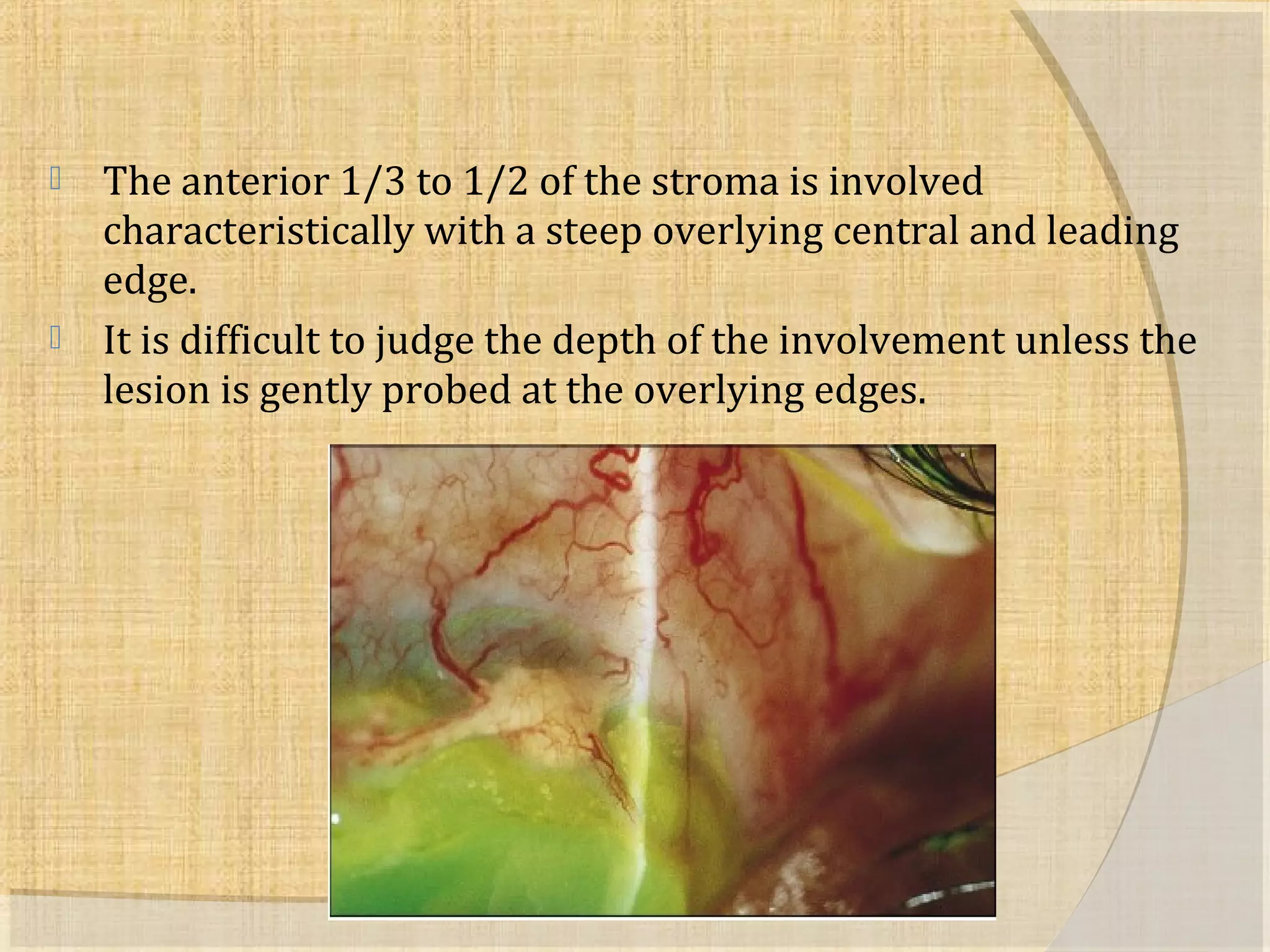  The anterior 1/3 to 1/2 of the stroma is involved 
characteristically with a steep overlying central and leading 
edge. 
 It is difficult to judge the depth of the involvement unless the 
lesion is gently probed at the overlying edges. 
 