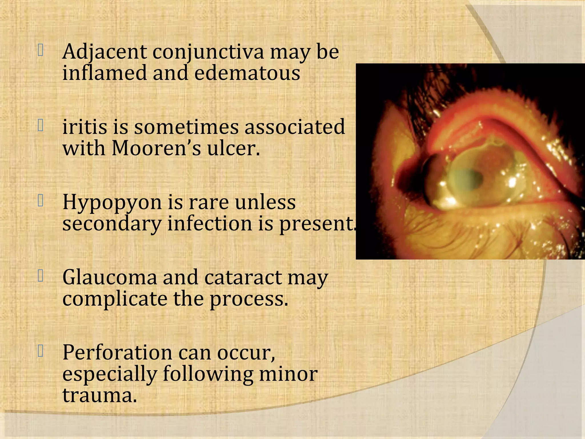  Adjacent conjunctiva may be 
inflamed and edematous 
 iritis is sometimes associated 
with Mooren’s ulcer. 
 Hypopyon is rare unless 
secondary infection is present. 
 Glaucoma and cataract may 
complicate the process. 
 Perforation can occur, 
especially following minor 
trauma. 
 