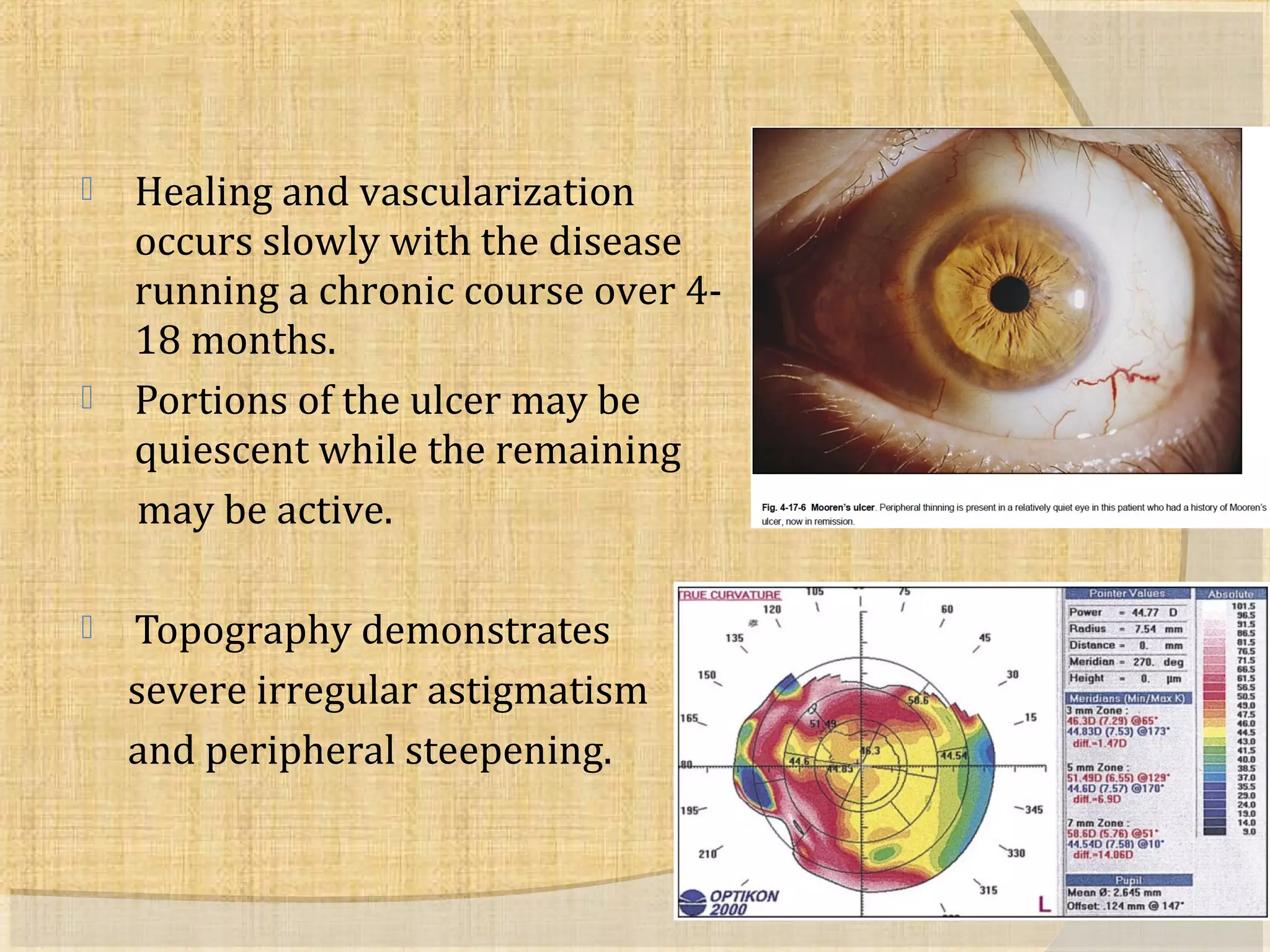  Healing and vascularization 
occurs slowly with the disease 
running a chronic course over 4- 
18 months. 
 Portions of the ulcer may be 
quiescent while the remaining 
may be active. 
 Topography demonstrates 
severe irregular astigmatism 
and peripheral steepening. 
 
