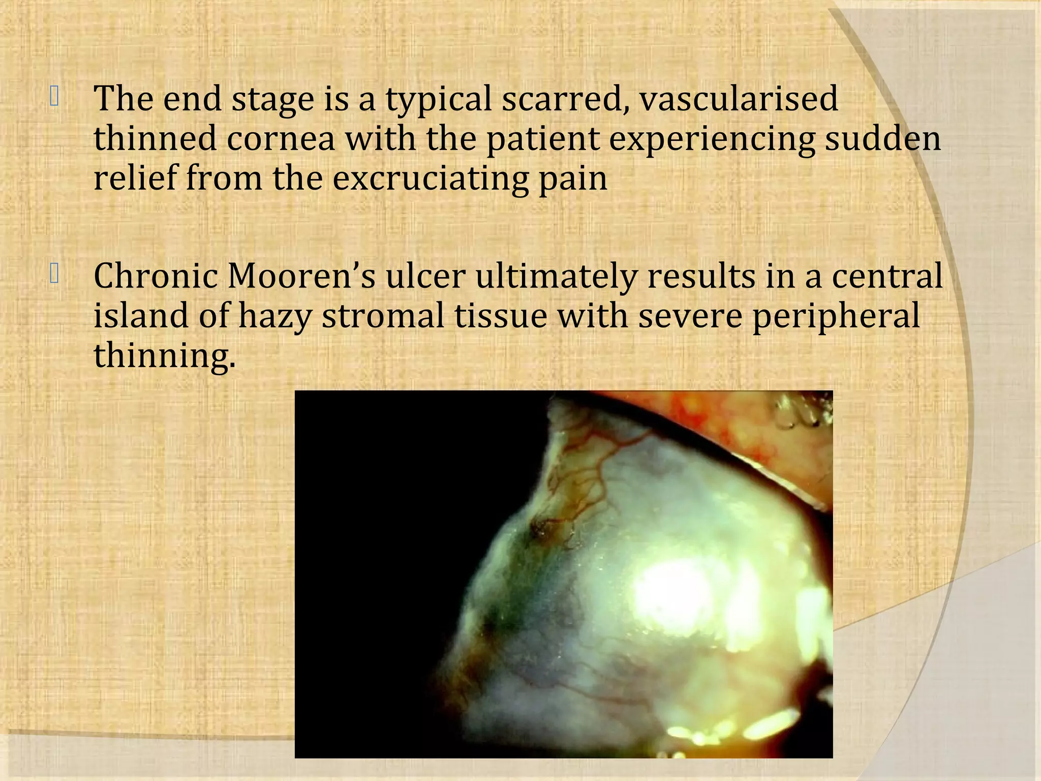  The end stage is a typical scarred, vascularised 
thinned cornea with the patient experiencing sudden 
relief from the excruciating pain 
 Chronic Mooren’s ulcer ultimately results in a central 
island of hazy stromal tissue with severe peripheral 
thinning. 
 