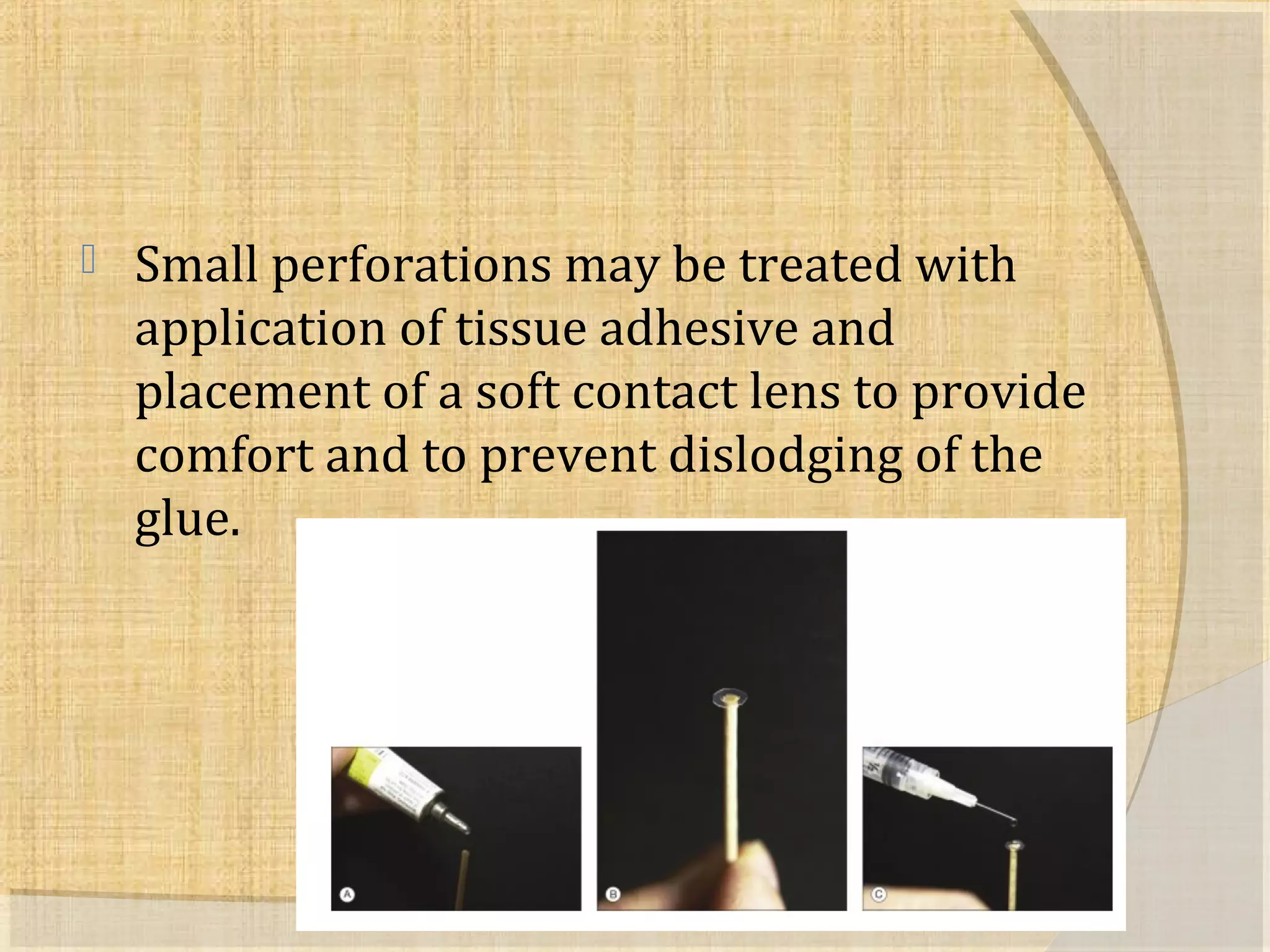  Small perforations may be treated with 
application of tissue adhesive and 
placement of a soft contact lens to provide 
comfort and to prevent dislodging of the 
glue. 
 