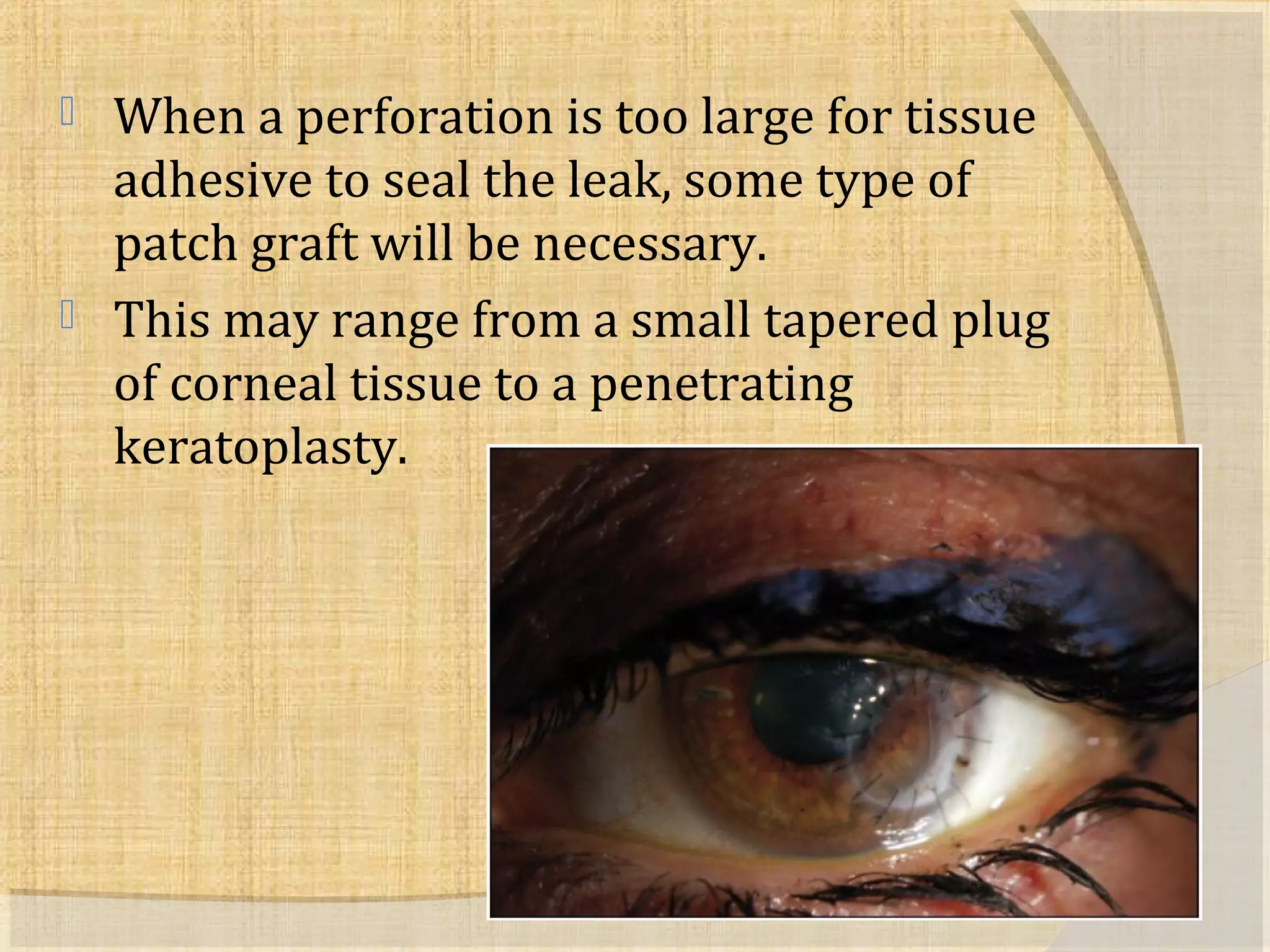  When a perforation is too large for tissue 
adhesive to seal the leak, some type of 
patch graft will be necessary. 
 This may range from a small tapered plug 
of corneal tissue to a penetrating 
keratoplasty. 
 