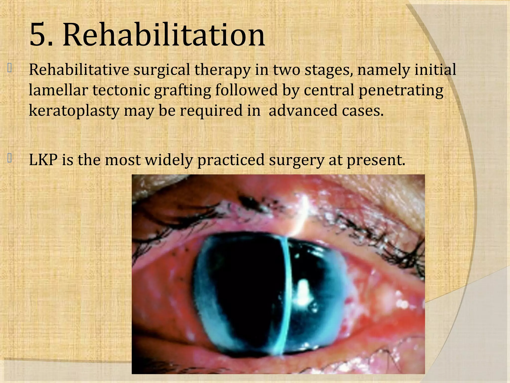 5. Rehabilitation 
 Rehabilitative surgical therapy in two stages, namely initial 
lamellar tectonic grafting followed by central penetrating 
keratoplasty may be required in advanced cases. 
 LKP is the most widely practiced surgery at present. 
 