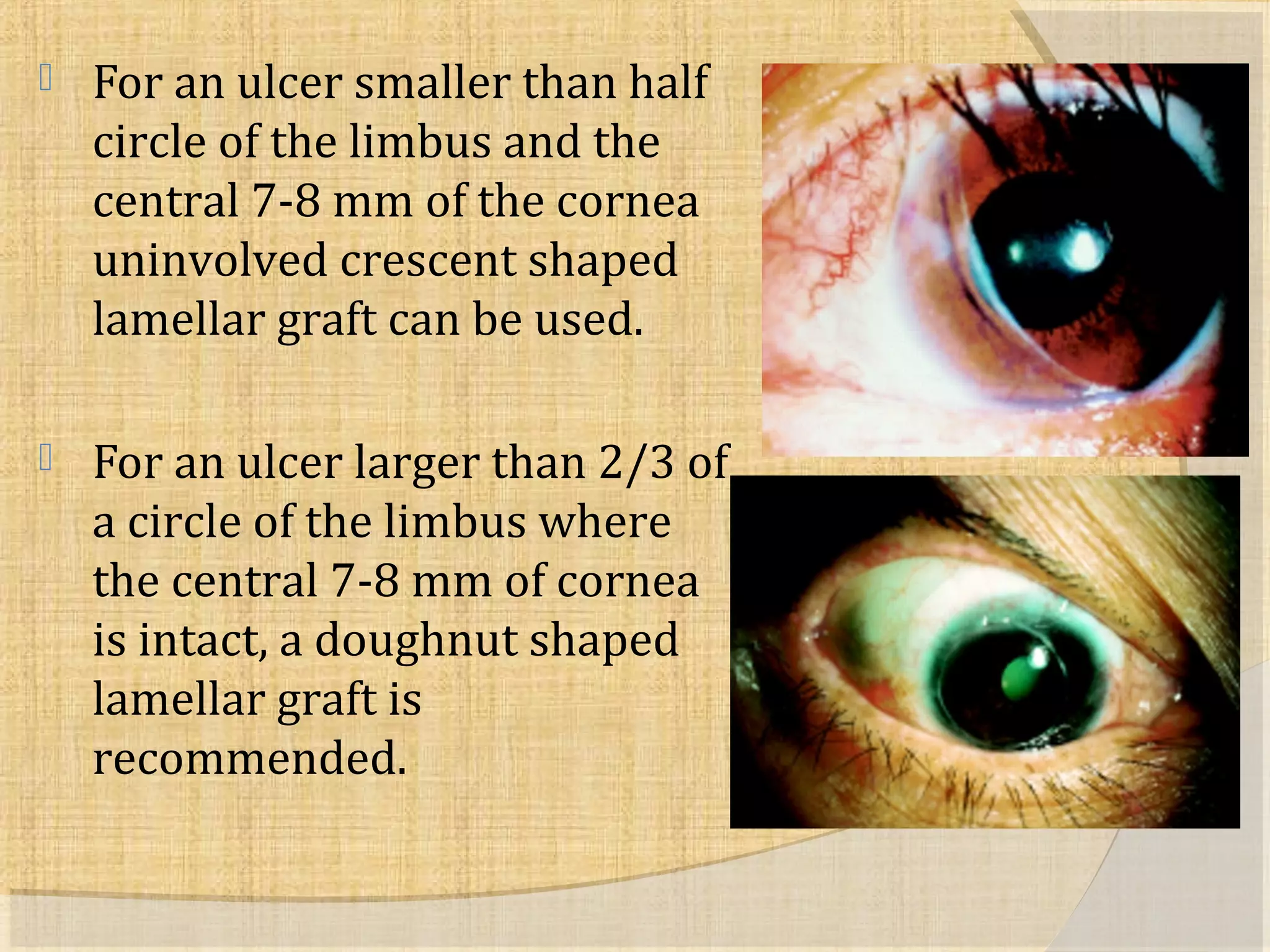  For an ulcer smaller than half 
circle of the limbus and the 
central 7-8 mm of the cornea 
uninvolved crescent shaped 
lamellar graft can be used. 
 For an ulcer larger than 2/3 of 
a circle of the limbus where 
the central 7-8 mm of cornea 
is intact, a doughnut shaped 
lamellar graft is 
recommended. 
 