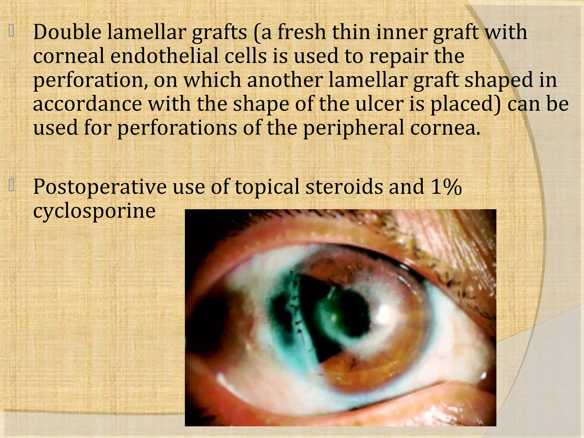  Double lamellar grafts (a fresh thin inner graft with 
corneal endothelial cells is used to repair the 
perforation, on which another lamellar graft shaped in 
accordance with the shape of the ulcer is placed) can be 
used for perforations of the peripheral cornea. 
 Postoperative use of topical steroids and 1% 
cyclosporine 
 