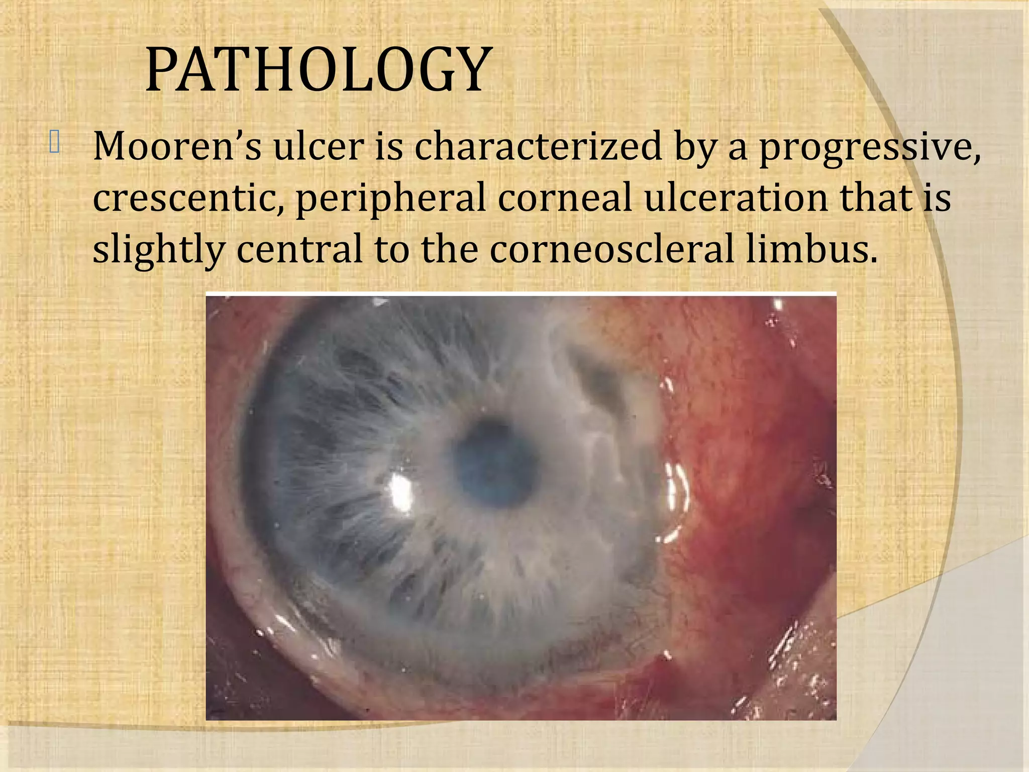 PATHOLOGY 
 Mooren’s ulcer is characterized by a progressive, 
crescentic, peripheral corneal ulceration that is 
slightly central to the corneoscleral limbus. 
 