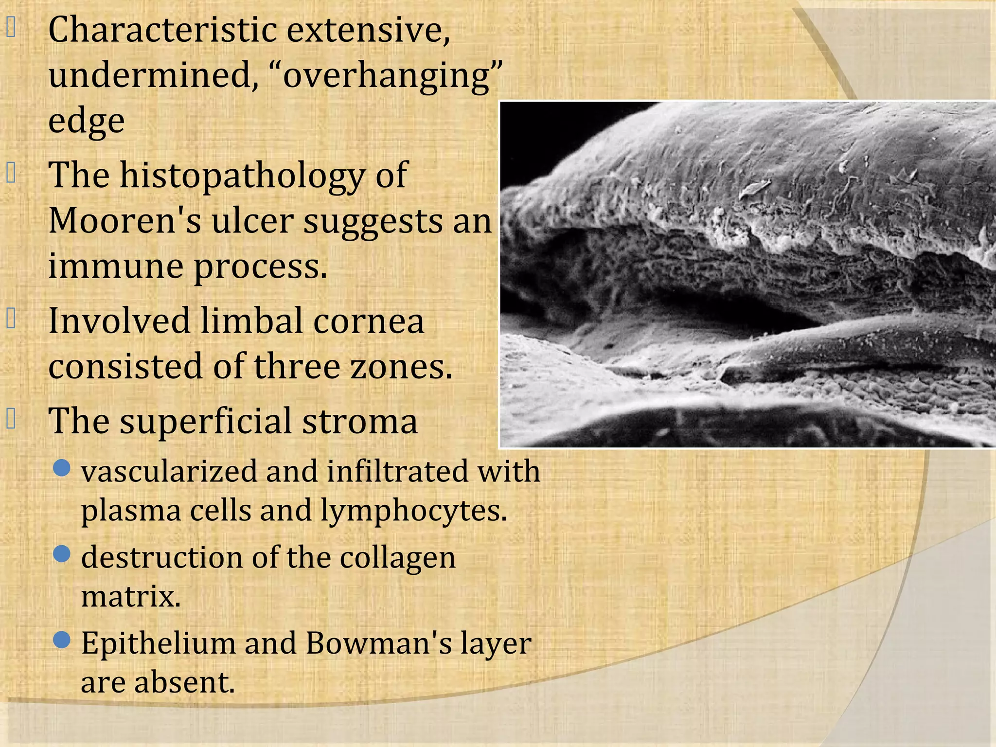  Characteristic extensive, 
undermined, “overhanging” 
edge 
 The histopathology of 
Mooren's ulcer suggests an 
immune process. 
 Involved limbal cornea 
consisted of three zones. 
 The superficial stroma 
vascularized and infiltrated with 
plasma cells and lymphocytes. 
destruction of the collagen 
matrix. 
Epithelium and Bowman's layer 
are absent. 
 