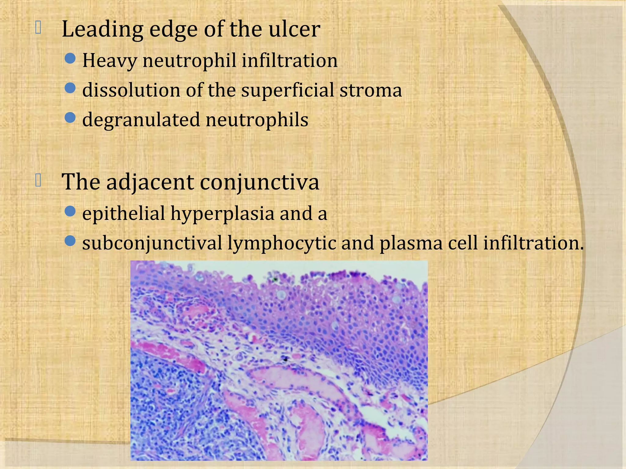  Leading edge of the ulcer 
Heavy neutrophil infiltration 
dissolution of the superficial stroma 
degranulated neutrophils 
 The adjacent conjunctiva 
epithelial hyperplasia and a 
subconjunctival lymphocytic and plasma cell infiltration. 
 