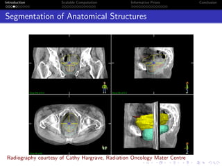 Introduction Scalable Computation Informative Priors Conclusion
Segmentation of Anatomical Structures
Radiography courtesy of Cathy Hargrave, Radiation Oncology Mater Centre
 