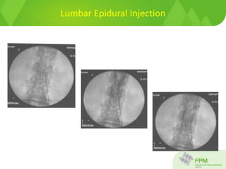 Lumbar Epidural Injection
 