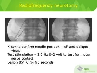 Radiofrequency neurotomy
X-ray to confirm needle position – AP and oblique
views
Test stimulation – 2.0 Hz 0–2 volt to test for motor
nerve contact
Lesion 85°C for 90 seconds
 