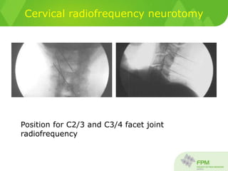 Cervical radiofrequency neurotomy
Position for C2/3 and C3/4 facet joint
radiofrequency
 