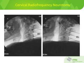 Cervical Radiofrequency Neurotomy
 