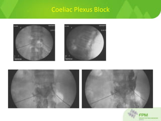 Coeliac Plexus Block
 