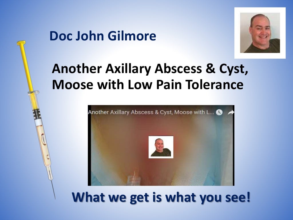 Another Axillary Abscess & Cyst, Moose with Low Pain Tolerance