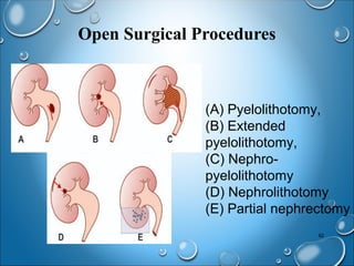 Mootrashmari wsr to urolithiasis | PPT