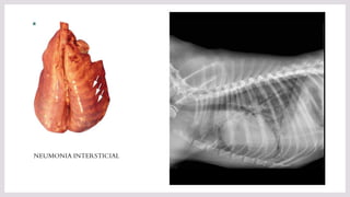 NEUMONIA INTERSTICIAL
 