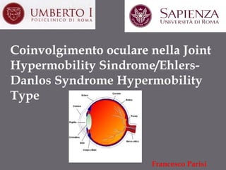 Coinvolgimento oculare nella Joint
Hypermobility Sindrome/EhlersDanlos Syndrome Hypermobility
Type

Francesco Parisi

 