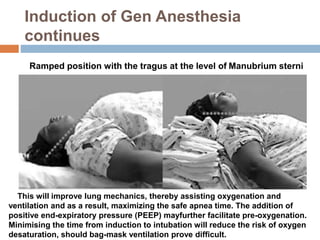 Morbid Obesity- Anesthesia concerns.pptx