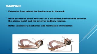 Intubation Ramping Morbid Obesity and Anaesthetic Considerations.pdf