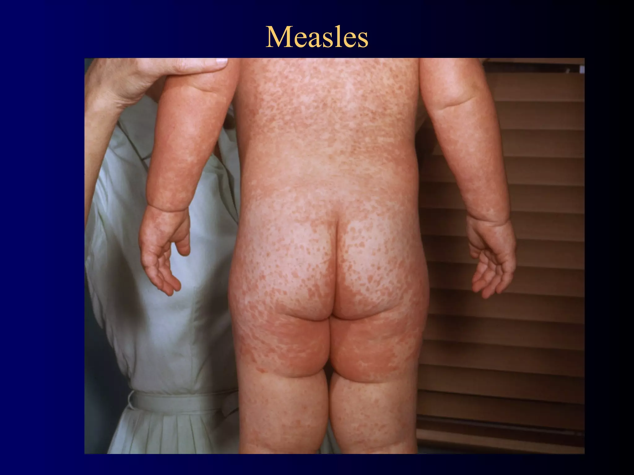 Measles
 