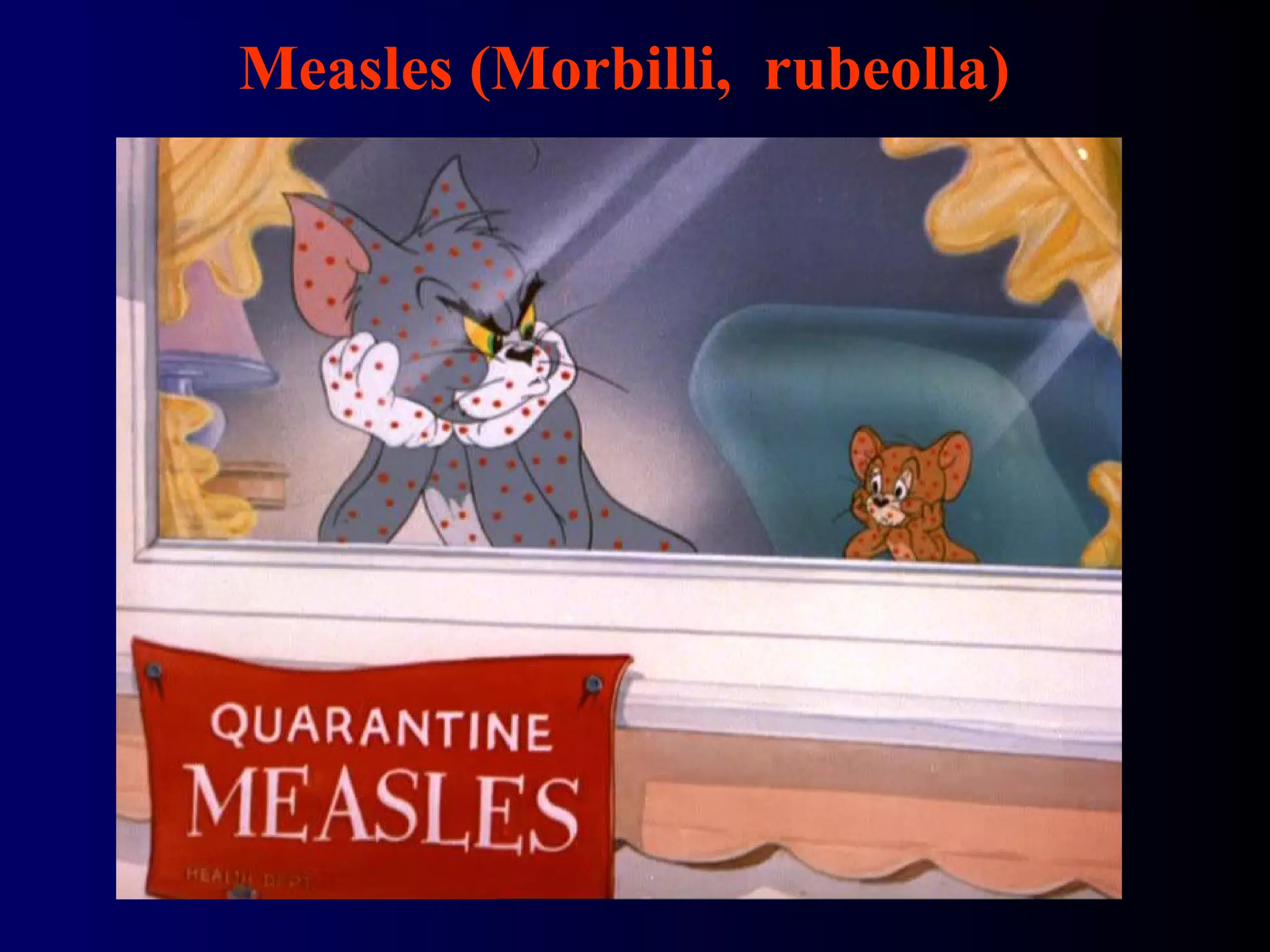 Measles (Morbilli, rubeolla)
 