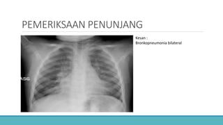 PEMERIKSAAN PENUNJANG
Kesan :
Bronkopneumonia bilateral
 