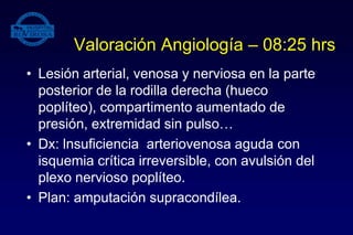 Valoración Angiología – 08:25 hrs
• Lesión arterial, venosa y nerviosa en la parte
posterior de la rodilla derecha (hueco
poplíteo), compartimento aumentado de
presión, extremidad sin pulso…
• Dx: lnsuficiencia arteriovenosa aguda con
isquemia crítica irreversible, con avulsión del
plexo nervioso poplíteo.
• Plan: amputación supracondílea.
 