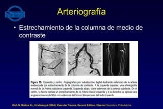 Arteriografía
• Estrechamiento de la columna de medio de
contraste
Rich N, Mattox KL, Hirshberg A (2004). Vascular Trauma. Second Edition. Elsevier Saunders, Philadelphia.
 