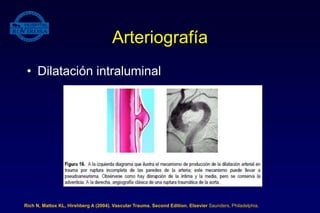 Arteriografía
• Dilatación intraluminal
Rich N, Mattox KL, Hirshberg A (2004). Vascular Trauma. Second Edition. Elsevier Saunders, Philadelphia.
 