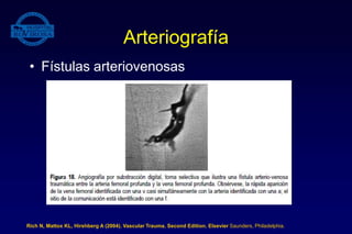Arteriografía
• Fístulas arteriovenosas
Rich N, Mattox KL, Hirshberg A (2004). Vascular Trauma. Second Edition. Elsevier Saunders, Philadelphia.
 