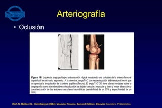 Arteriografía
• Oclusión
Rich N, Mattox KL, Hirshberg A (2004). Vascular Trauma. Second Edition. Elsevier Saunders, Philadelphia.
 