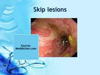 Skip lesions
Source:
Meddiction.com
 
